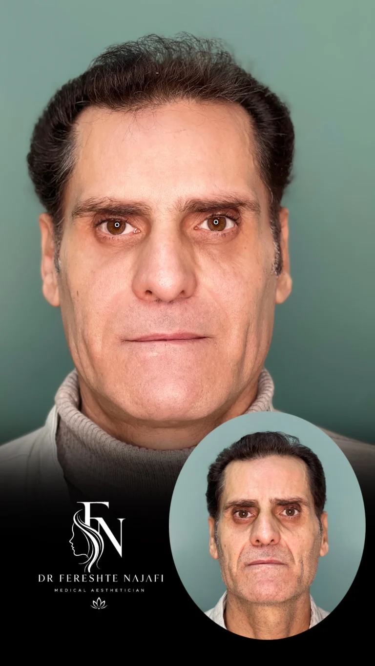 تزریق فول فیس